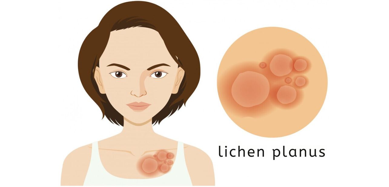 Lichen Planus