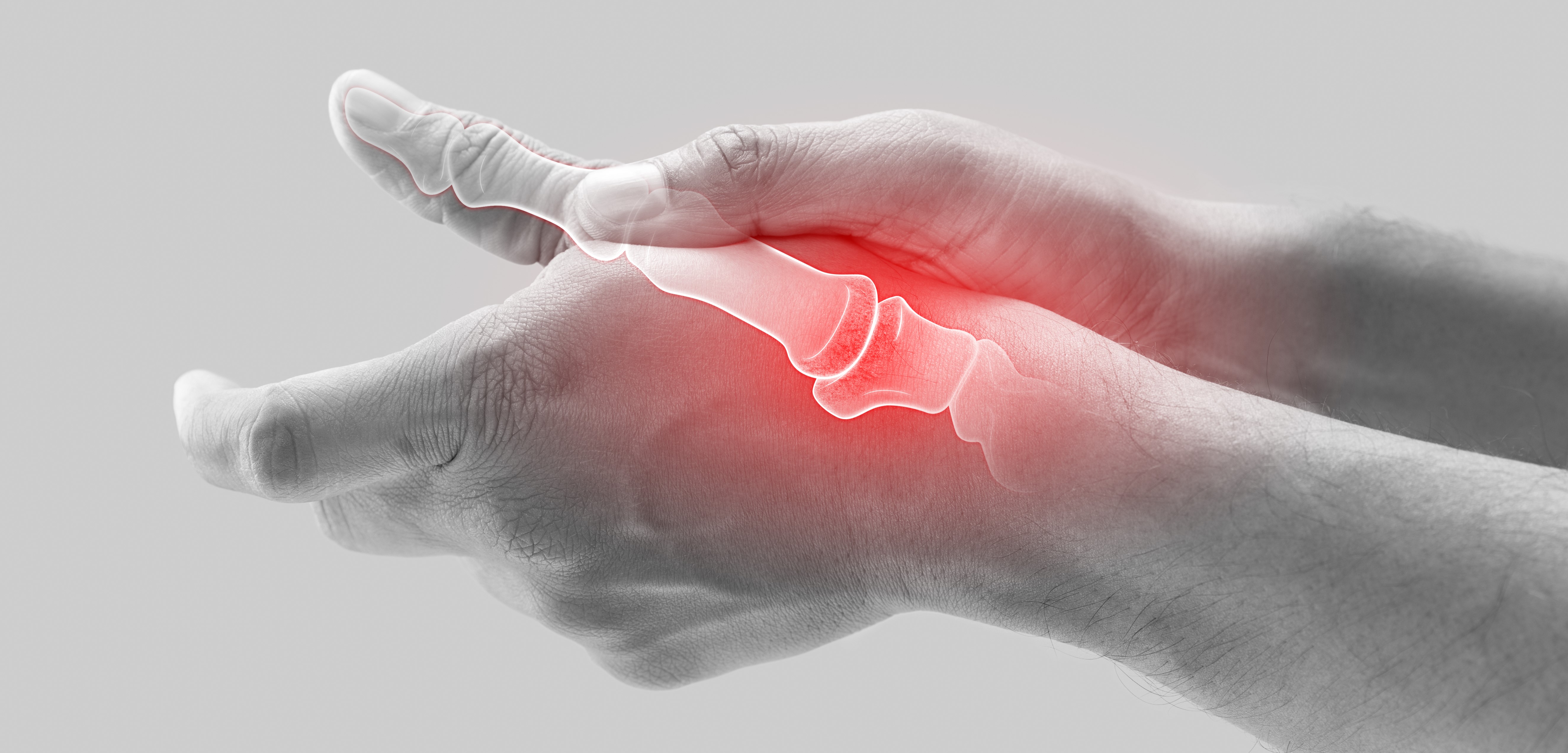 Arthritis