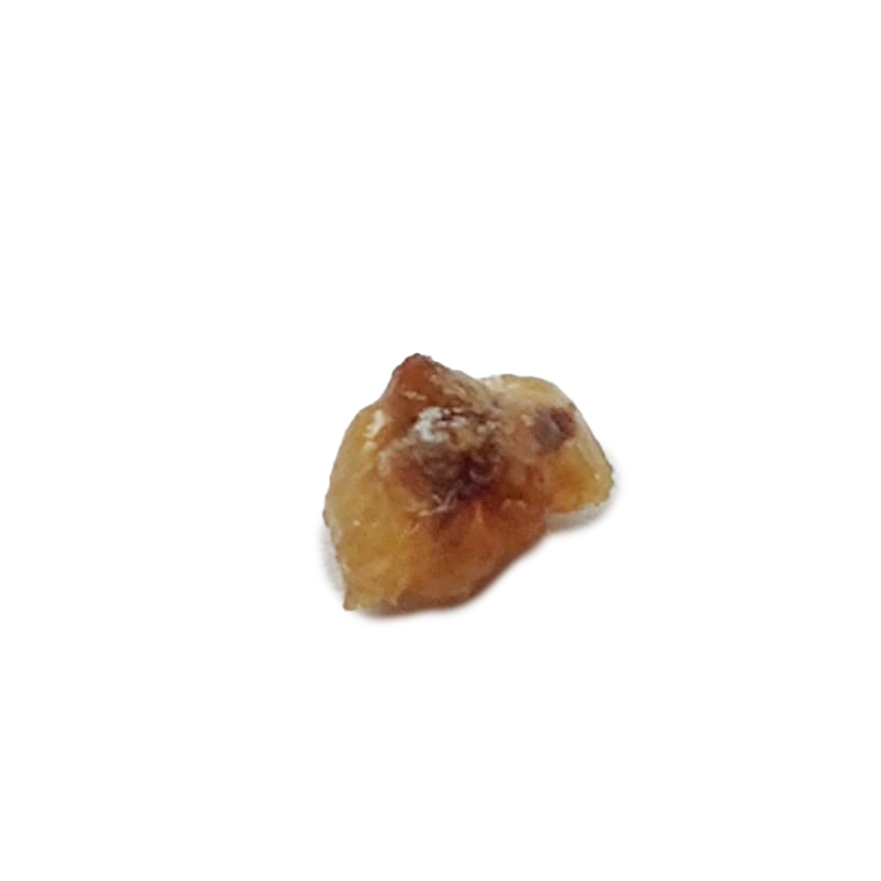 Photograph of the renal calculi that was passed after homeopathic medication