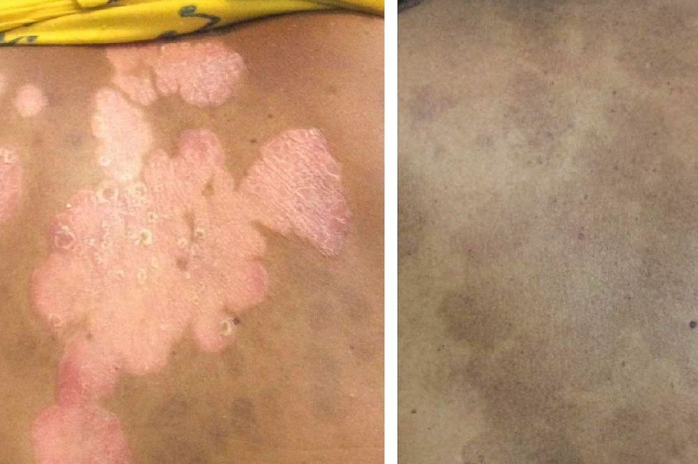 Treatment of Psorasis