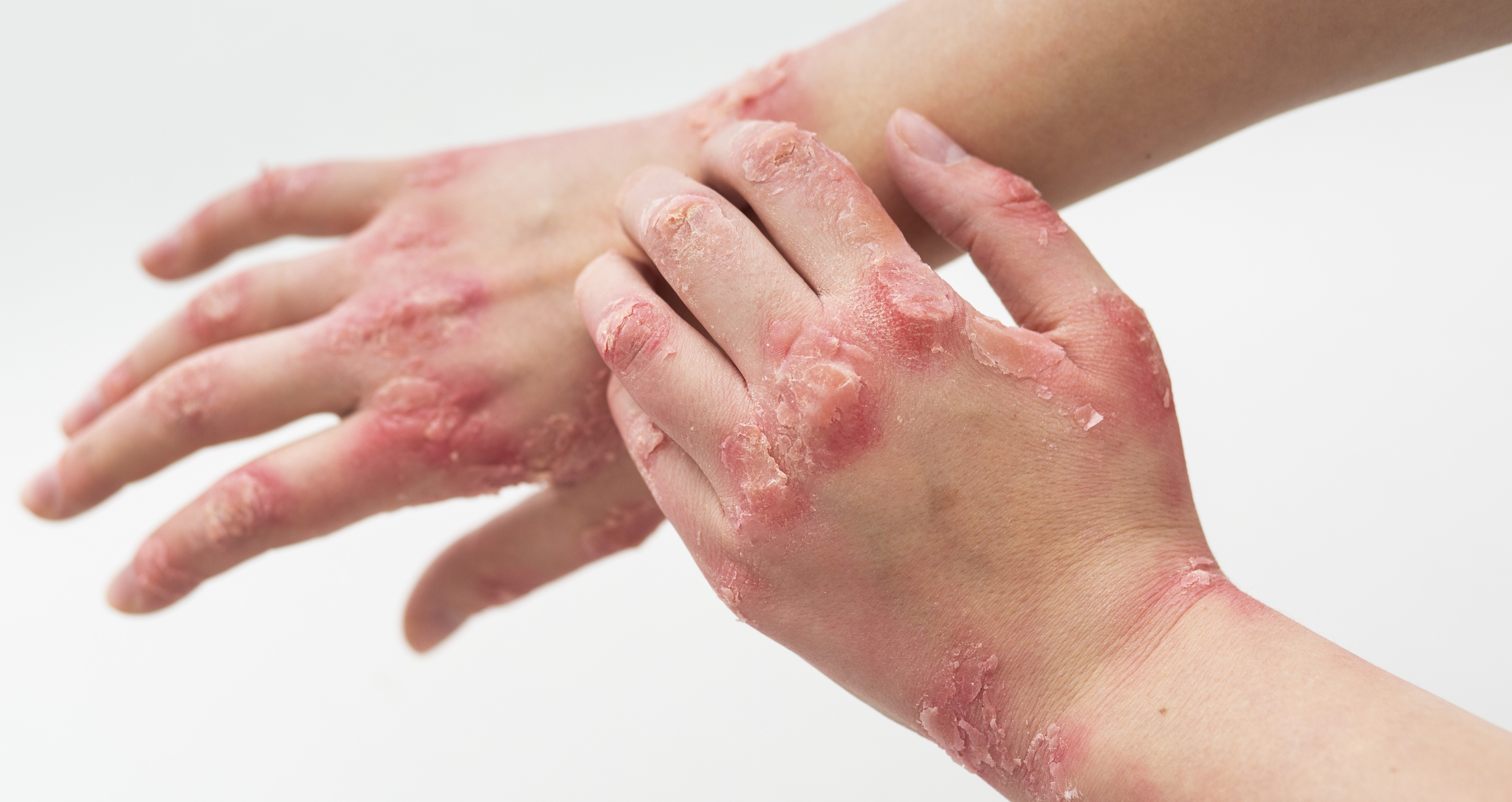 psoriasis