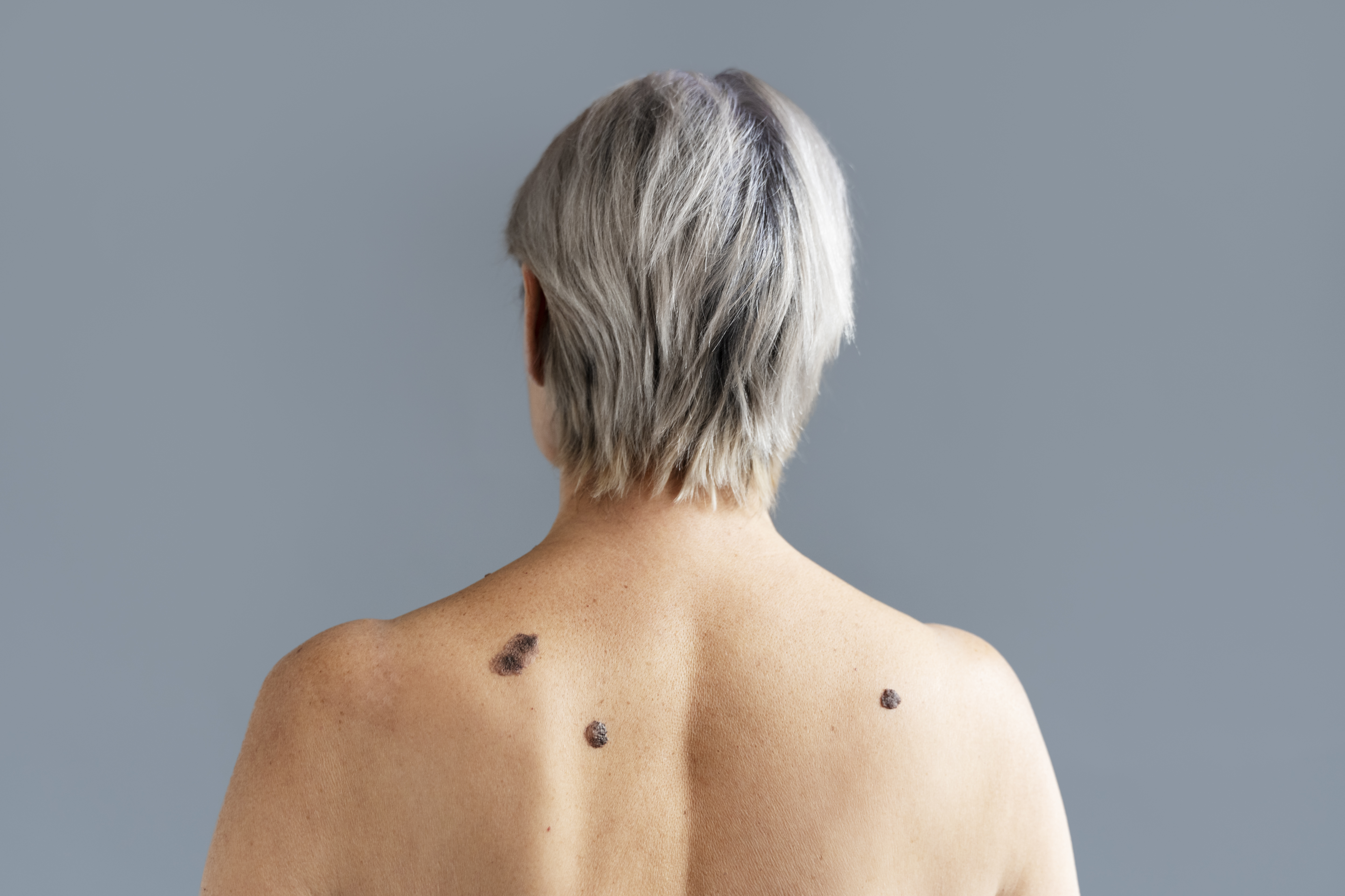 person suffering from wart